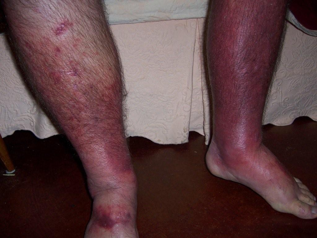Swollen Legs 67